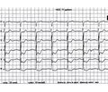 Management of patient with acute coronary syndrome without ST elevation: focusing on antithrombotic therapy