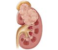 Long-term results of surgical treatment of patients with renal cell carcinoma