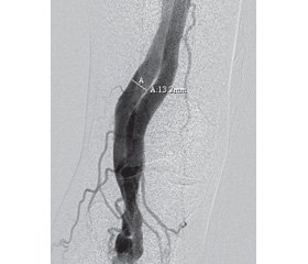 Late complications after “classical” phlebectomy in the system of the small saphenous vein
