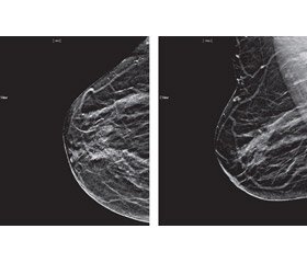 Сучасні методи медичної візуалізації в діагностиці  й скринінгу раку молочної залози