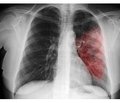 A clinical case of successful treatment of severe community-acquired pneumonia associated with influenza BH3N2 virus