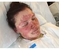 Clinical case of successful treatment of neuroleptic malignant syndrome on the background of acute toxic-allergic reaction degree IV