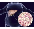 Type 2 diabetes mellitus and non-alcoholic fatty liver disease: new opportunities for therapeutic correction