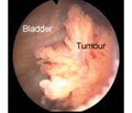 Partial cystectomy with adjuvant chemotherapy or radiation therapy for muscle invasive bladder cancer (literature review)
