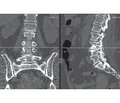 Studying the results of CT myelography application in patients  with lumbar spinal stenosis