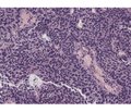 Molecular pathology of urothelial carcinoma: prognostic and predictive biomarkers