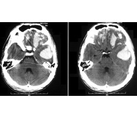 Профилактика инфекций при тяжелых повреждениях мозга: акцентирование на вентилятор-ассоциированную пневмонию и наружное вентрикулярное дренирование