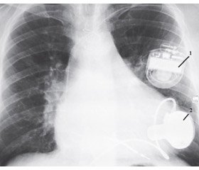 Analysis of hemorrhagic and thromboembolic complications  in patients with implanted left ventricular assist devices