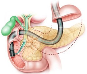 The combination of endoscopic and laparoscopic techniques in the treatment of acute cholangitis