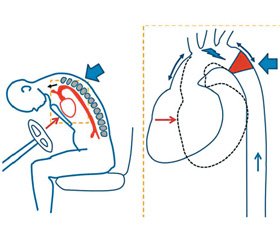 Травма сердца: классификация, механизмы и проблемы диагностики у пострадавших с травмой грудной клетки (литературный обзор с результатами собственных наблюдений)