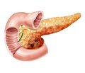 Chronic pancreatitis: about some complications and features of their pathogenesis and course
