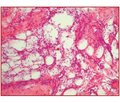 Аналіз патоморфологічних особливостей очеревини у хворих, повторно оперованих на органах черевної порожнини на тлі спайкової хвороби очеревини