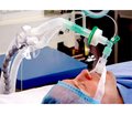 Дискусійні питання механічної вентиляції легень у хворих із черепно-мозковою травмою, ускладненою респіраторним дистрес-синдромом