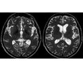 Clinical Observation of the Patient with Advanced Form of Neurosyphilis