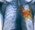 Сучасний стан питання діагностики туберкульозу