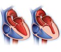 Прогностическое значение уровня галектина-3 у больных гипертрофической кардиомиопатией