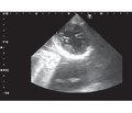 Клинический случай радиочастотной абляции межжелудочковой перегородки у пациента с обструктивной формой гипертрофической кардиомиопатии