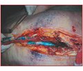 An Anatomical Study of Epidural Dye Spread after Caudal Injection in Adults