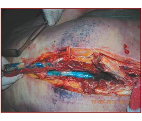 Анатомическое исследование эпидурального распространения краски после каудальной инъекции у взрослых