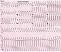 A clinical case of persistent ventricular fibrillation on the background of Torsade de pointes syndrome and multiple electroimpulse therapy — defibrillation