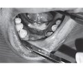 Clinical characteristics of potentially malignant formations of the mucous membrane of the mouth cavity and lips