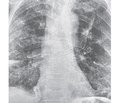 Key aspects in the treatment of severe community-acquired viral-bacterial pneumonia