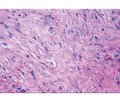 Clinical case of breast myoepithelioma