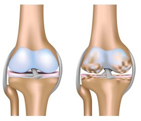 Дайджест. Ревматология. Остеоартроз