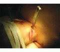 Случай хирургического лечения проникающего осложненного ножевого ранения на уровне позвонков С3-С4