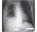 Осложненная пневмококковая пневмония у ребенка: клинический случай