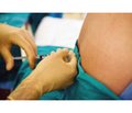 Оптимизация анестезиологической защиты при кесаревом сечении