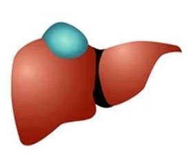 Радикальное хирургическое лечение больших солитарных кист печени