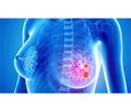 Prognostic and predictive value of tumor-infiltrating lymphocytes in breast cancer (literature review)