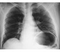 Diaphragm Dysfunction in Children with Acute Respiratory Failure