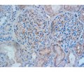 Mesangial proliferative glomerulonephritis with monoclonal immunoglobulin deposits: why nephrobiopsy is crucial