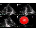 Factors associated with restoration of the right ventricle function according to 2D-speckle-tracking echocardiography in patients with acute pulmonary embolism