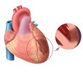 Омоложение инфарктов миокарда и инсультов: современные методы профилактики