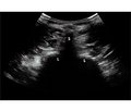 Ultrasound-assisted technique in urgent traumatology