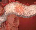 Ферментная терапия хронического панкреатита с внешнесекреторной недостаточностью поджелудочной железы