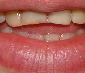 Вопросы преподавания проблем профилактики патологической стираемости твердых тканей зубов на кафедре ортопедической стоматологии