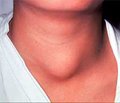 Неотложные неврологические состояния при патологии щитовидной железы
